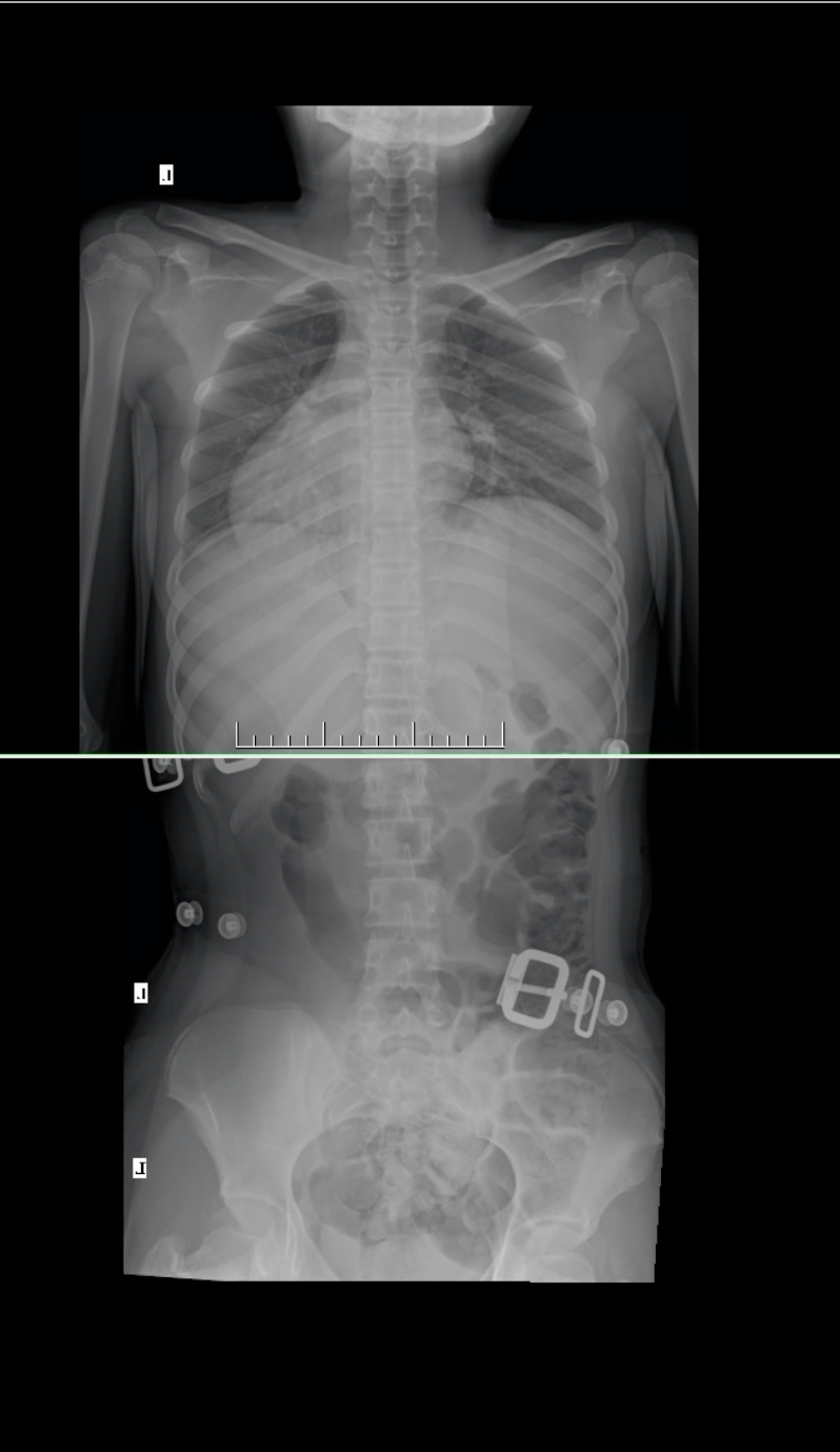 In brace Xray