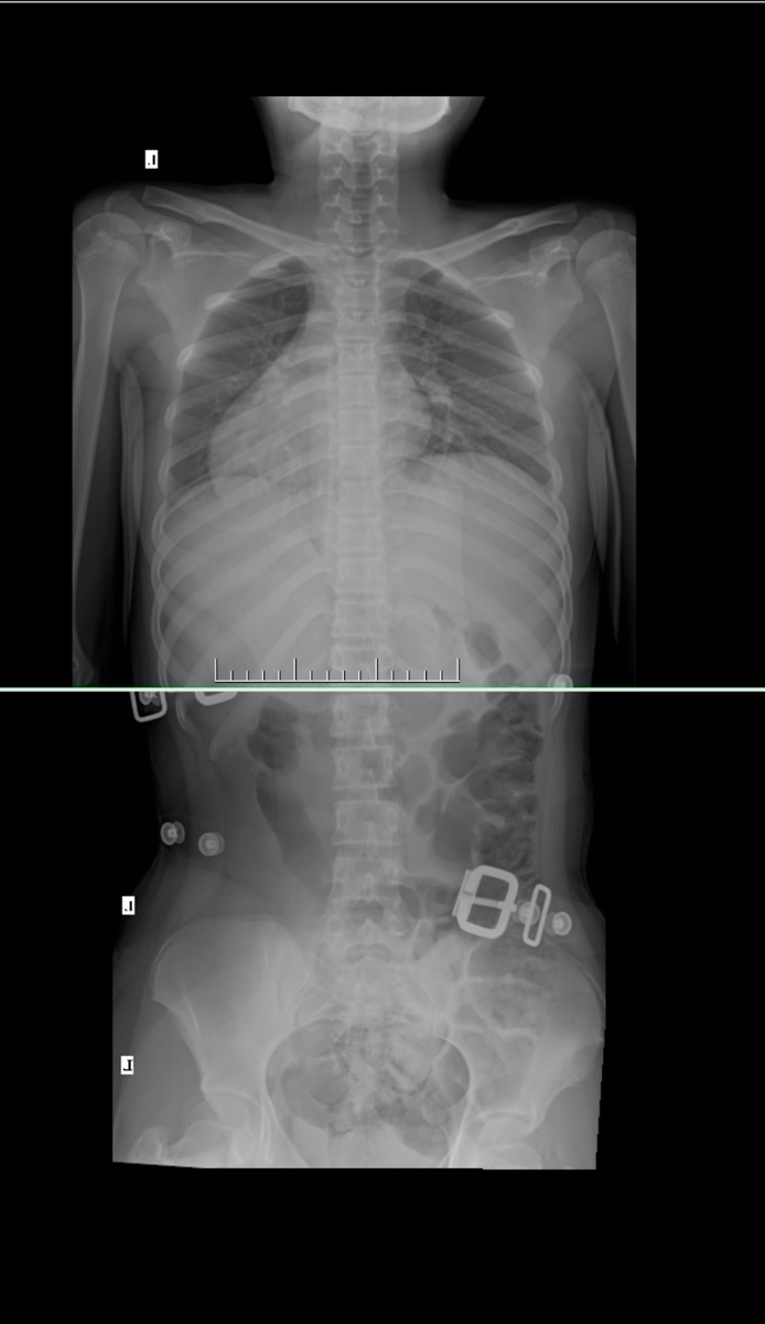 In brace Xray
