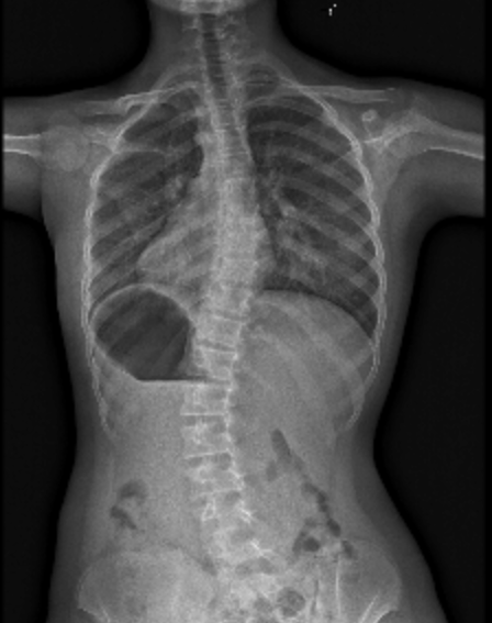 Pre brace Xray_cropped