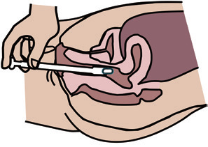 vaginal pessaries with adaptor
